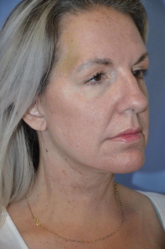 Facelift plastic surgery before and after photo Dallas
