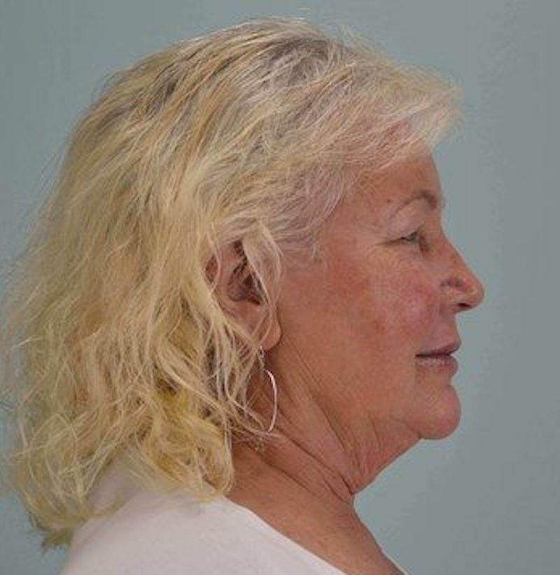 Facelift plastic surgery before and after pictures Dallas